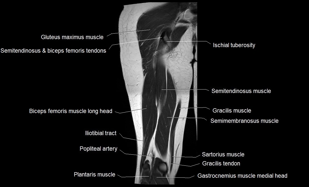 MRI thigh coronal cross sectional anatomy image 18.webp